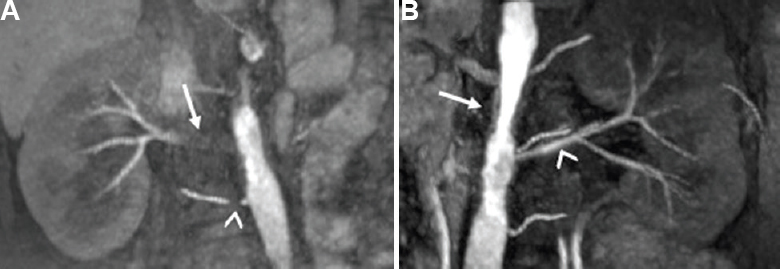 A 24 yr old hypertensive female patient with chronic kidney disease and aortoarteritis. Non-contrast magnetic resonance angiography of ArTery and VEins 3D True fast imaging with steady-state precession reformatted coronal magnetic resonance angiography images (A) 90-95 per cent stenosis with wall thickening in right main renal artery (arrow) and 80-90 per cent stenosis in right accessory renal artery (arrowhead). (B) Irregularity of aorta with wall thickening (arrow) and normal left renal artery (arrowhead).